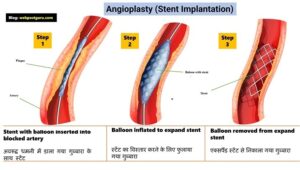 Angioplasty and stent placement