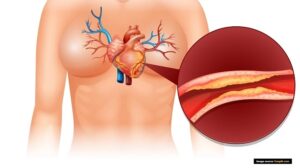 Causes of ischemic heart disease in Hindi