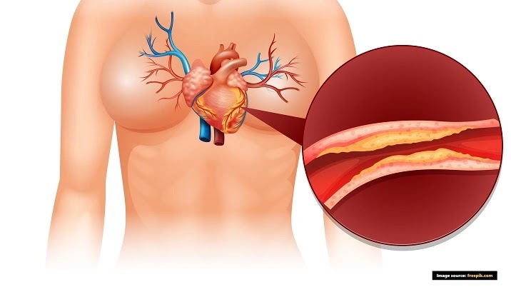 Causes of ischemic heart disease in Hindiइस्किमिक हृदय रोगइस्कीमिक हृदय रोगइस्कैमिक हार्ट रोगहार्ट अटैक मायोकार्डियल इस्किमिया