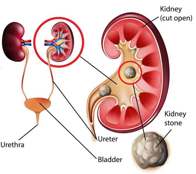 Causes Kidney Stone in Hindi