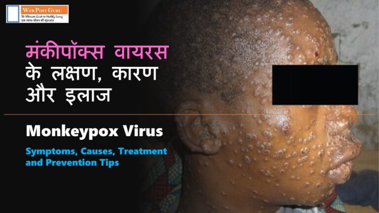 Monkeypox Virus Symptoms | मंकीपॉक्स वायरस के लक्षण, कारण और इलाज