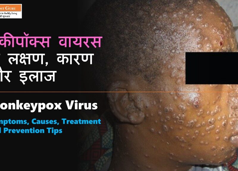 Monkeypox Virus symptoms in Hindi