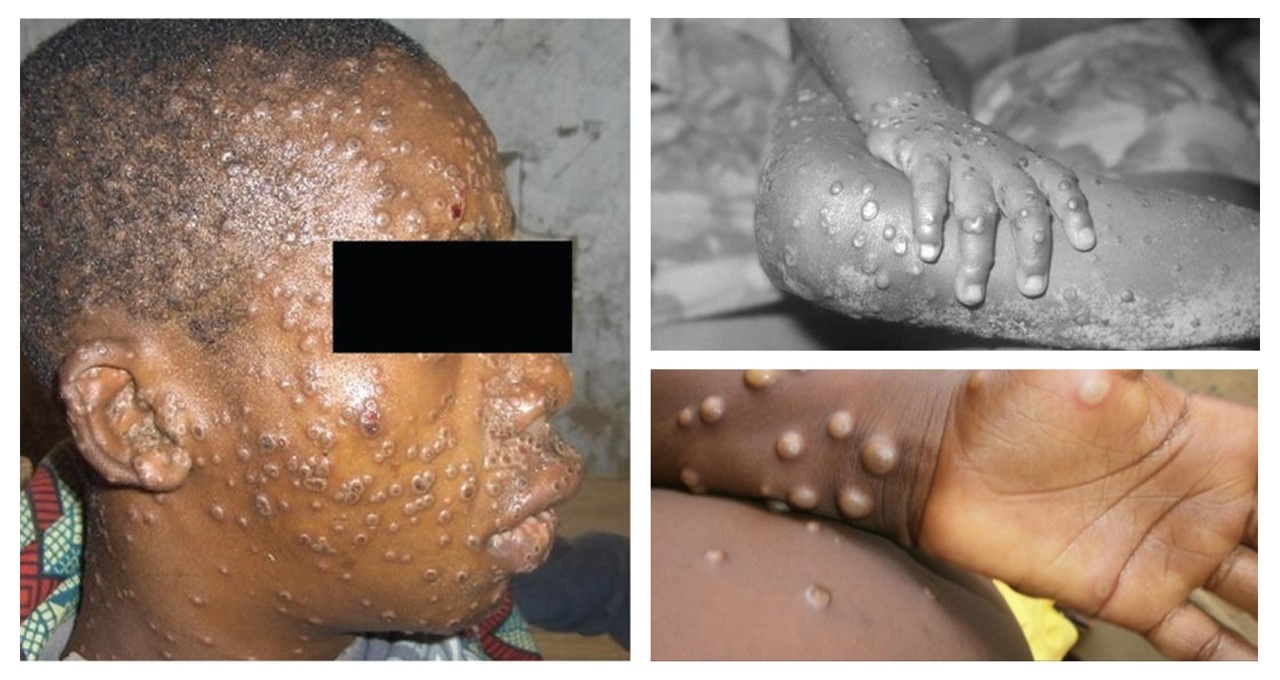 Monkeypox virus pictures मंकीपॉक्स के लक्षण मंकीपॉक्स बीमारी मंकीपॉक्स रोग