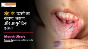 Mouth Ulcers in Hindi