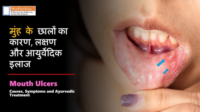 Mouth Ulcers (मुंह के छाले) का कारण, लक्षण, दवा व आयुर्वेदिक इलाज 