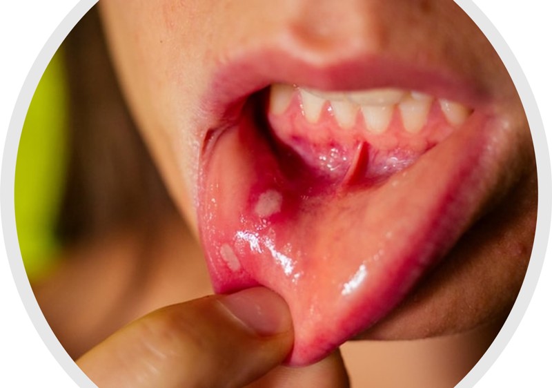 Mouth ulcer reason in Hindi