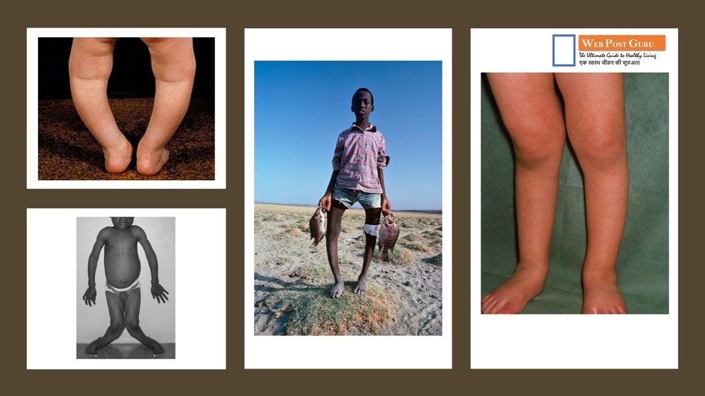 Pictures of Rickets in Hindi