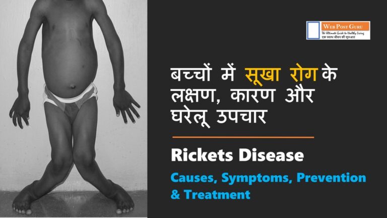 Rickets Disease | बच्चों में सूखा रोग | रिकेट्स के लक्षण, कारण और घरेलू उपचार