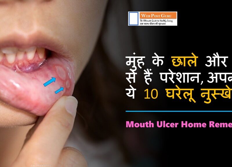 Mouth Ulcer Home Remedies in Hindi