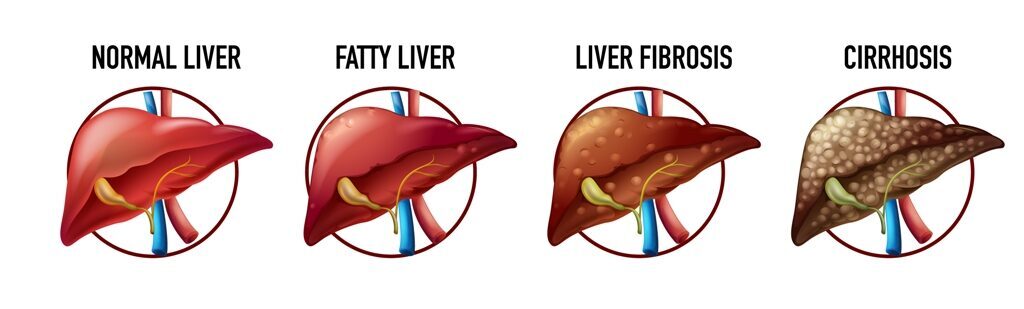 Liver cirrhosis stages in Hindi