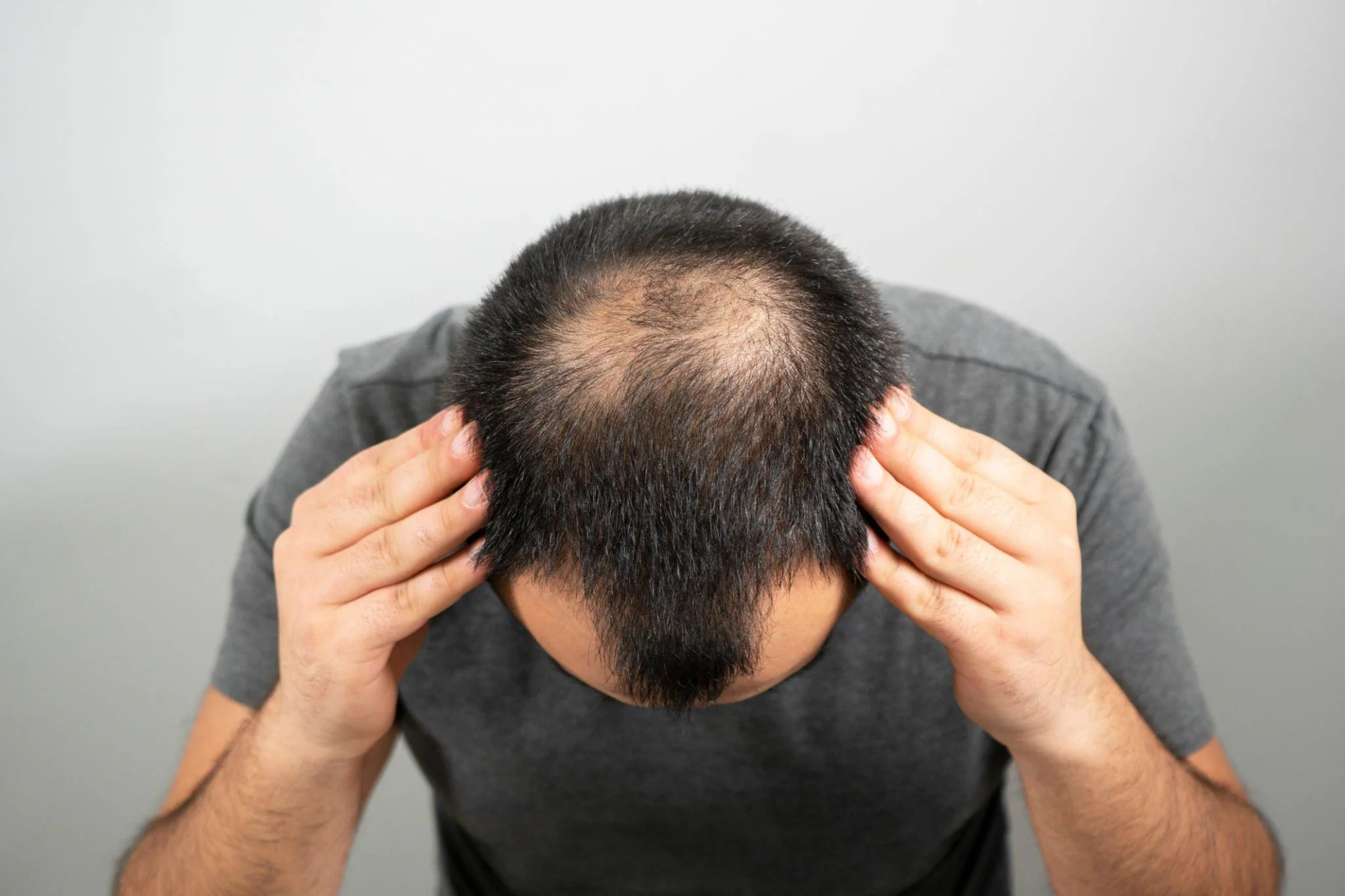 Hair loss Treatment in Hindi