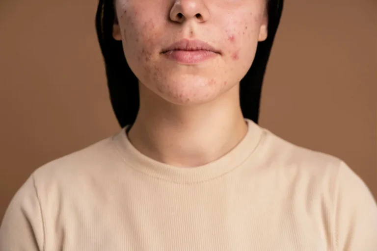 How to Remove Pimples: पिम्पल्स को जड़ से खत्म कैसे करें? जानिए इसके उपाय